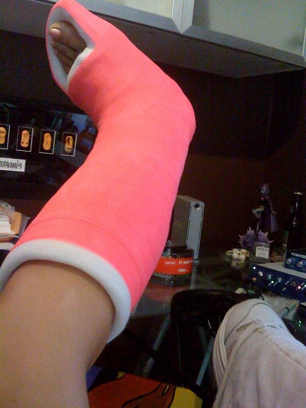 broken ankle pink cast